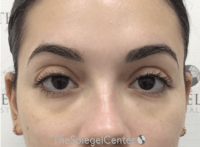 Tear Trough / Under Eye Fillers Before & After Gallery - Patient 189271 - Image 2