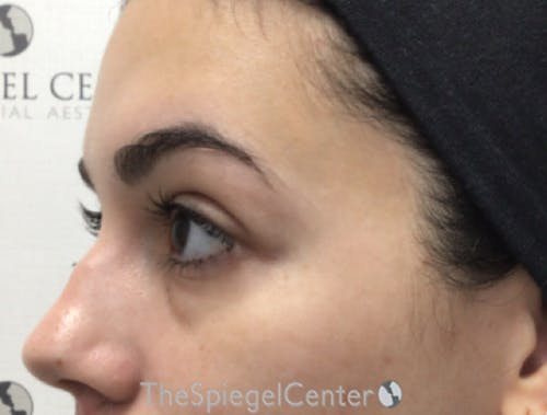 Tear Trough / Under Eye Fillers Before & After Gallery - Patient 189271 - Image 3