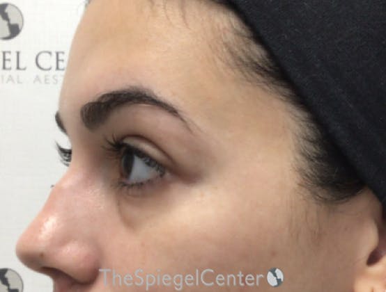 Tear Trough / Under Eye Fillers Before & After Gallery - Patient 189271 - Image 3