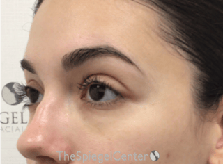 Tear Trough / Under Eye Fillers Before & After Gallery - Patient 189271 - Image 4
