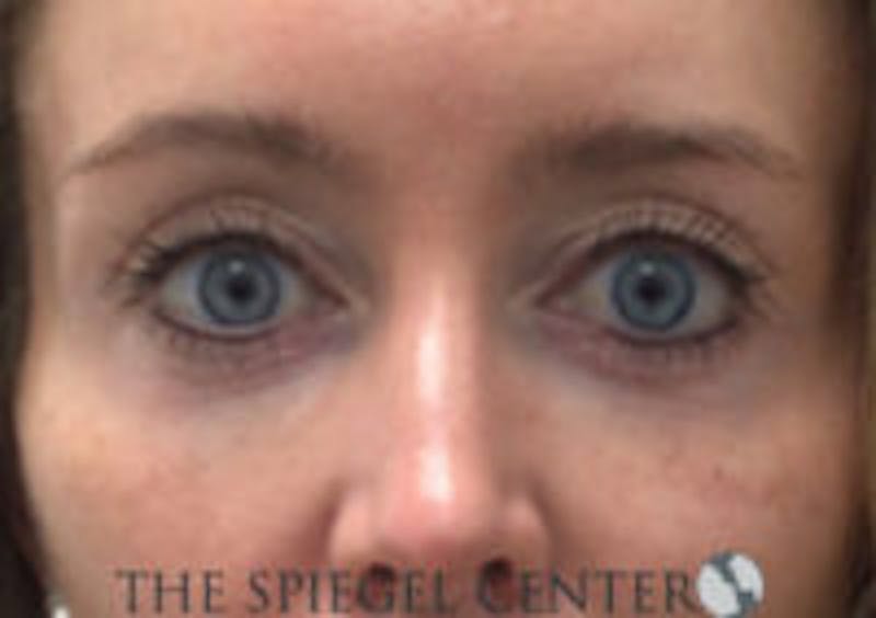 Tear Trough / Under Eye Fillers Before & After Gallery - Patient 899146 - Image 1