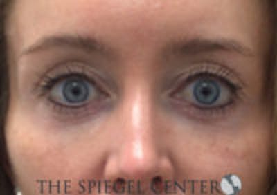 Tear Trough / Under Eye Fillers Before & After Gallery - Patient 899146 - Image 1