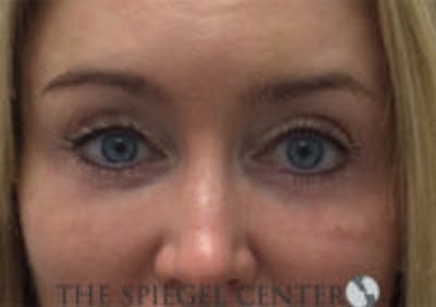 Tear Trough / Under Eye Fillers Before & After Gallery - Patient 899146 - Image 2