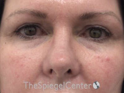 Tear Trough / Under Eye Fillers Before & After Gallery - Patient 436089 - Image 1