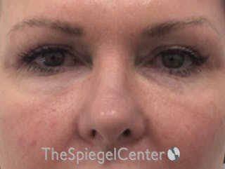 Tear Trough / Under Eye Fillers Before & After Gallery - Patient 436089 - Image 2