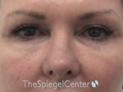 Tear Trough / Under Eye Fillers Before & After Gallery - Patient 436089 - Image 2