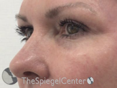 Tear Trough / Under Eye Fillers Before & After Gallery - Patient 436089 - Image 4