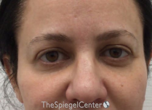 Tear Trough / Under Eye Fillers Before & After Gallery - Patient 926701 - Image 1