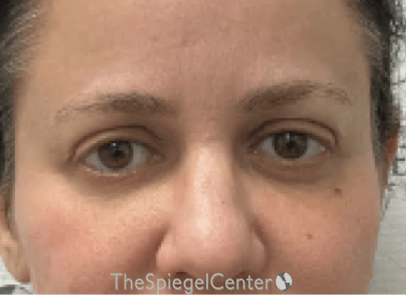 Tear Trough / Under Eye Fillers Before & After Gallery - Patient 926701 - Image 2
