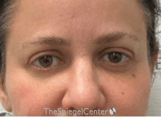 Tear Trough / Under Eye Fillers Before & After Gallery - Patient 926701 - Image 2