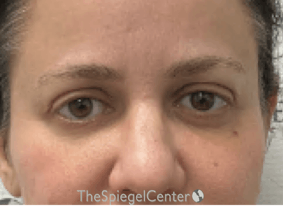 Tear Trough / Under Eye Fillers Before & After Gallery - Patient 926701 - Image 2