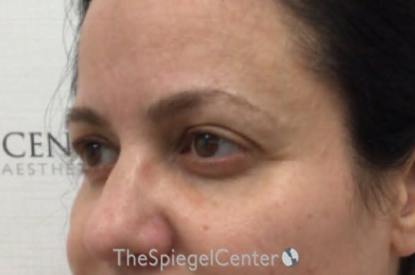 Tear Trough / Under Eye Fillers Before & After Gallery - Patient 926701 - Image 3