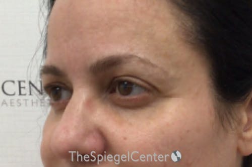 Tear Trough / Under Eye Fillers Before & After Gallery - Patient 926701 - Image 3