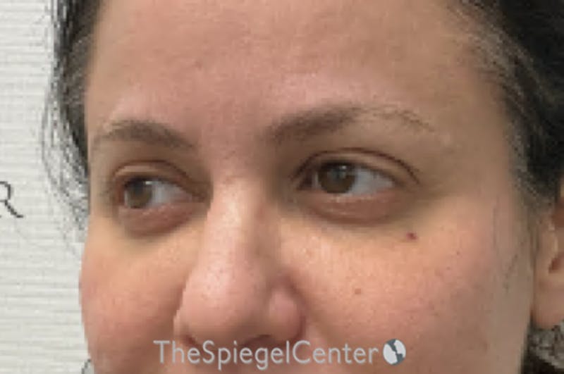 Tear Trough / Under Eye Fillers Before & After Gallery - Patient 926701 - Image 4