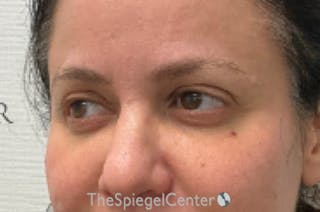 Tear Trough / Under Eye Fillers Before & After Gallery - Patient 926701 - Image 4