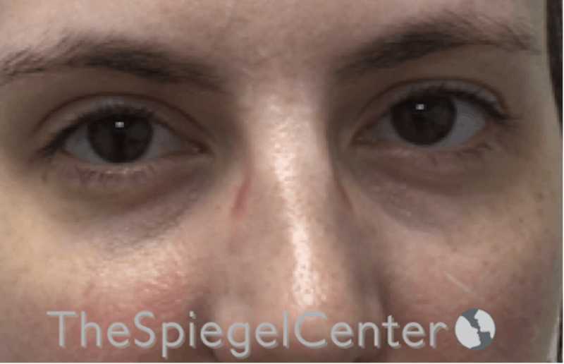 Tear Trough / Under Eye Fillers Before & After Gallery - Patient 293037 - Image 1