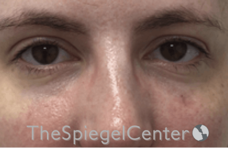 Tear Trough / Under Eye Fillers Before & After Gallery - Patient 293037 - Image 2