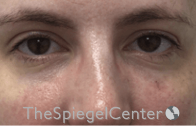 Tear Trough / Under Eye Fillers Before & After Gallery - Patient 293037 - Image 2