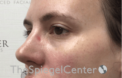 Tear Trough / Under Eye Fillers Before & After Gallery - Patient 293037 - Image 3