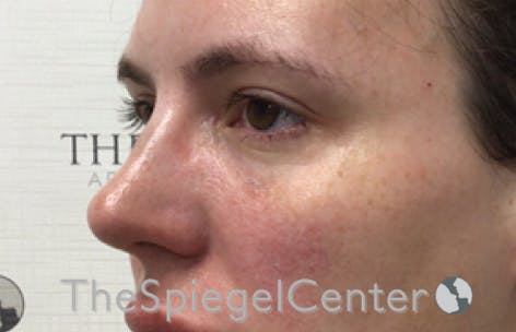 Tear Trough / Under Eye Fillers Before & After Gallery - Patient 293037 - Image 4
