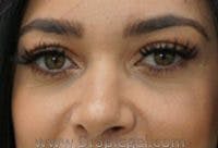 Tear Trough / Under Eye Fillers Before & After Gallery - Patient 366773 - Image 1