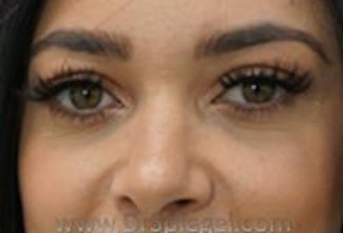 Tear Trough / Under Eye Fillers Before & After Gallery - Patient 366773 - Image 1