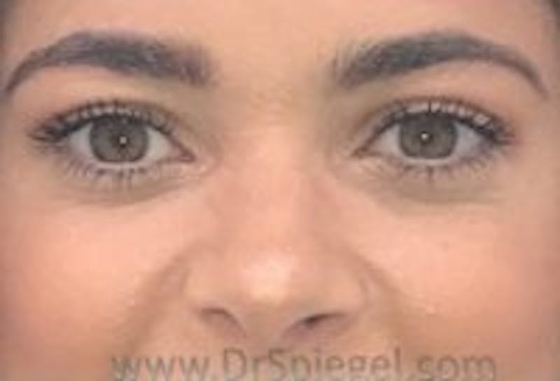 Tear Trough / Under Eye Fillers Before & After Gallery - Patient 366773 - Image 2