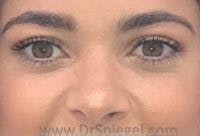 Tear Trough / Under Eye Fillers Before & After Gallery - Patient 366773 - Image 2