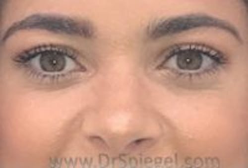 Tear Trough / Under Eye Fillers Before & After Gallery - Patient 366773 - Image 2
