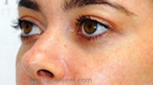 Tear Trough / Under Eye Fillers Before & After Gallery - Patient 366773 - Image 3