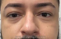 Tear Trough / Under Eye Fillers Before & After Gallery - Patient 428014 - Image 1