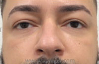 Tear Trough / Under Eye Fillers Before & After Gallery - Patient 428014 - Image 2
