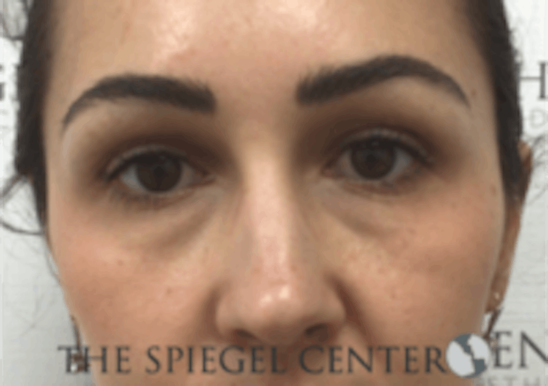 Tear Trough / Under Eye Fillers Before & After Gallery - Patient 410506 - Image 1