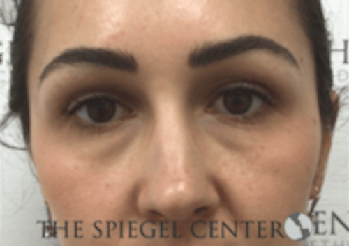 Tear Trough / Under Eye Fillers Before & After Gallery - Patient 410506 - Image 1