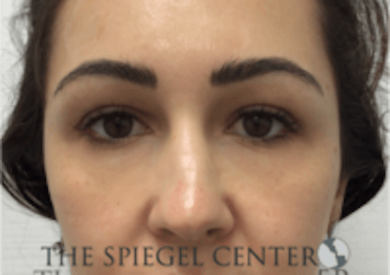 Tear Trough / Under Eye Fillers Before & After Gallery - Patient 410506 - Image 2