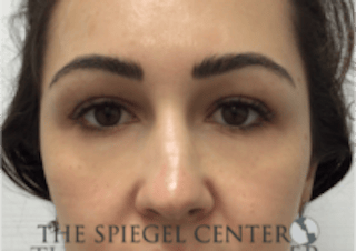 Tear Trough / Under Eye Fillers Before & After Gallery - Patient 410506 - Image 2