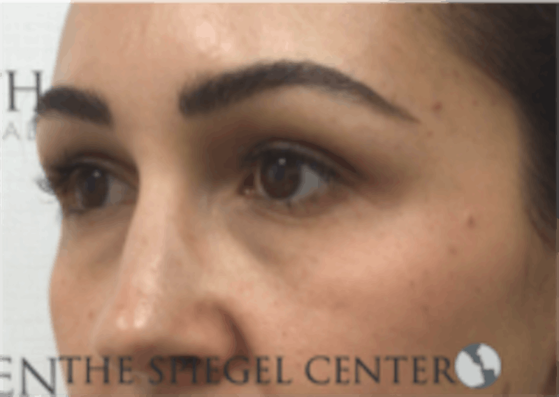 Tear Trough / Under Eye Fillers Before & After Gallery - Patient 410506 - Image 3