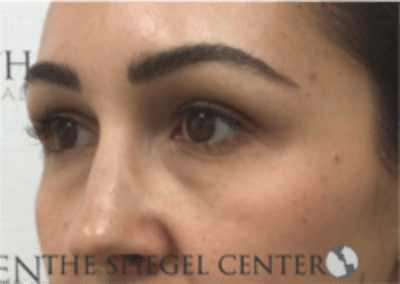 Tear Trough / Under Eye Fillers Before & After Gallery - Patient 410506 - Image 3