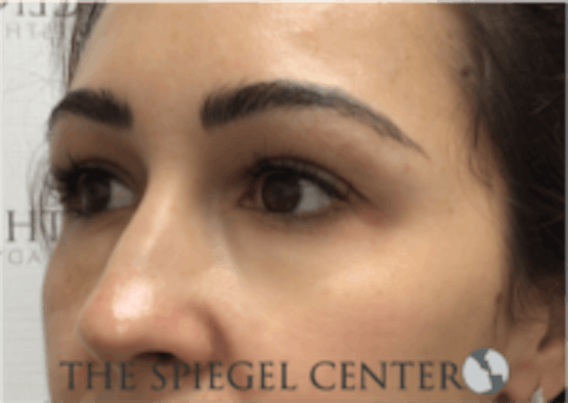 Tear Trough / Under Eye Fillers Before & After Gallery - Patient 410506 - Image 4