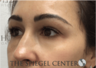 Tear Trough / Under Eye Fillers Before & After Gallery - Patient 410506 - Image 4