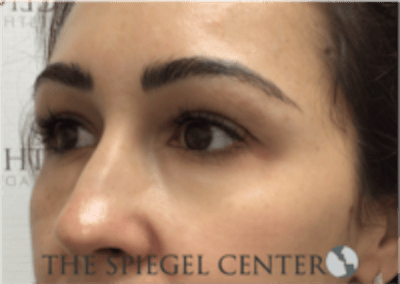 Tear Trough / Under Eye Fillers Before & After Gallery - Patient 410506 - Image 4