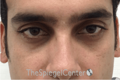 Upper Eyelid Filler Before & After Gallery - Patient 342622 - Image 1