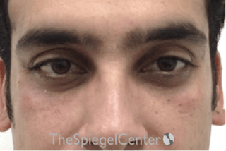 Tear Trough / Under Eye Fillers Before & After Gallery - Patient 165579 - Image 2
