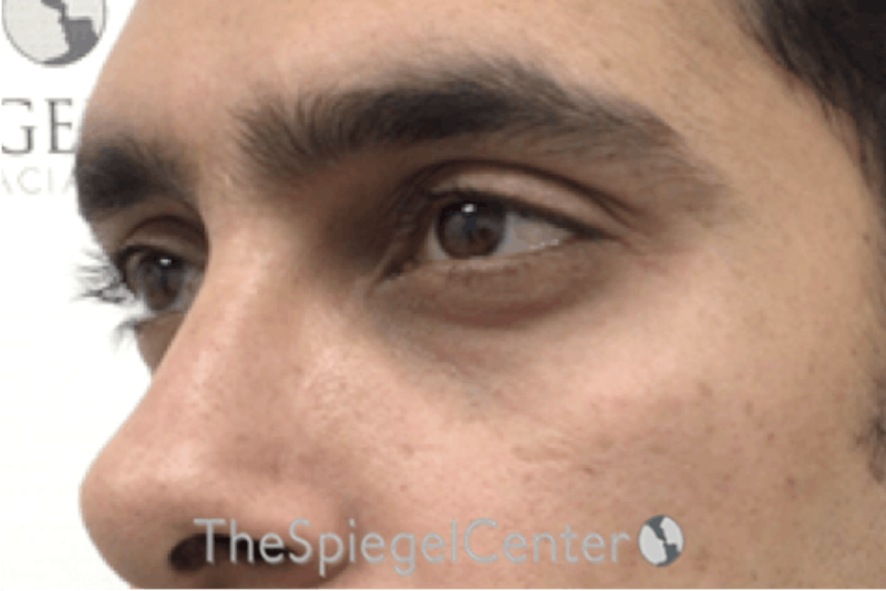 Tear Trough / Under Eye Fillers Before & After Gallery - Patient 165579 - Image 3