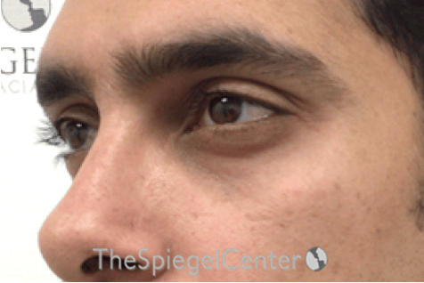 Tear Trough / Under Eye Fillers Before & After Gallery - Patient 165579 - Image 3