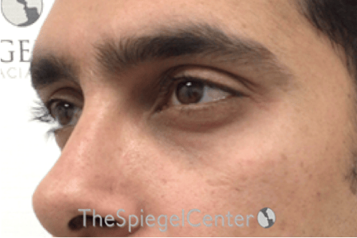 Upper Eyelid Filler Before & After Gallery - Patient 342622 - Image 3