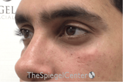 Upper Eyelid Filler Before & After Gallery - Patient 342622 - Image 4