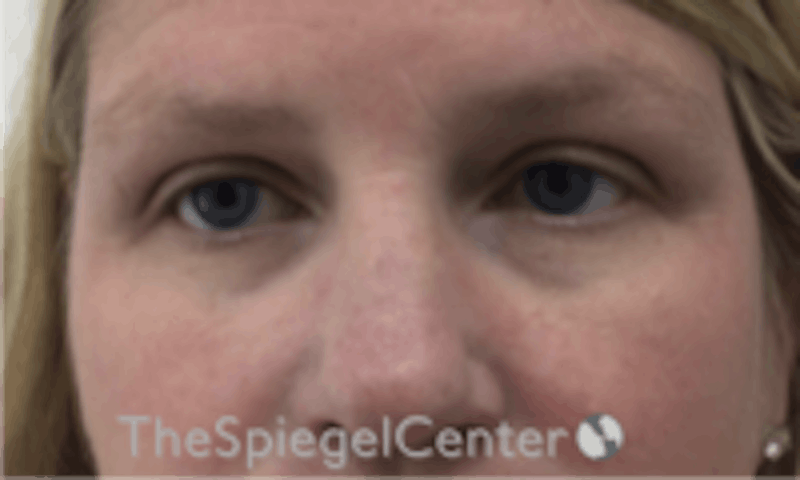 Temple Filler Before & After Gallery - Patient 985172 - Image 1