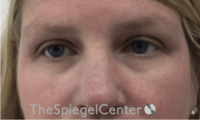 Tear Trough / Under Eye Fillers Before & After Gallery - Patient 241672 - Image 1