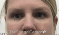 Tear Trough / Under Eye Fillers Before & After Gallery - Patient 241672 - Image 2
